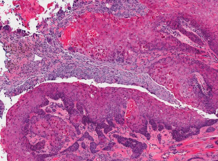 Malignant proliferating pilar tumor showing cellular and mitotic atypia as well as areas of necrosis (H&E, original magnification ×40).