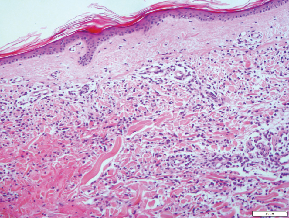 Histopathology of a skin biopsy showed a dense cellular infiltrate extending from the reticular dermis leading to separation of collagen bundles in the subcutis