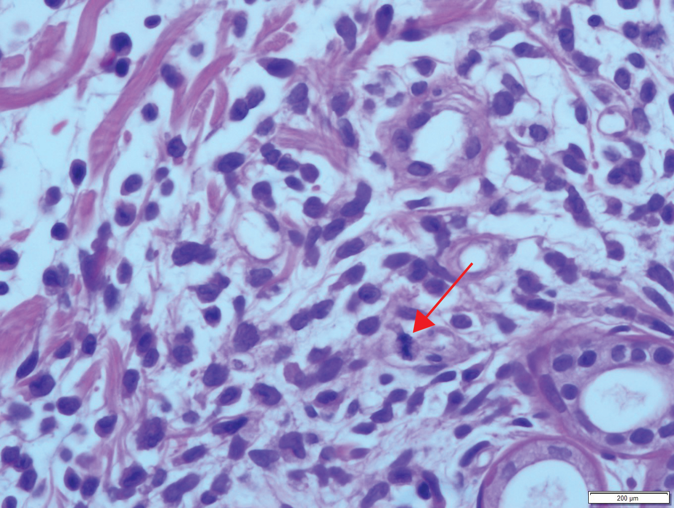 A mitotic figure in the right lower quadrant (arrow) and numerous notched nuclei