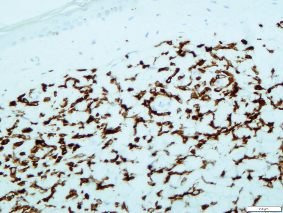 Leukemic cells stained positively for leukocyte common antigen on immunohistochemical staining