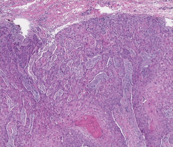 Squamous Cell Carcinoma in Hidradenitis Suppurativa 