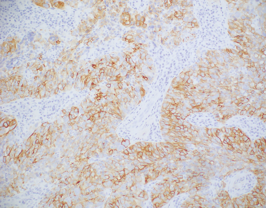 Positive cytokeratin 7 immunohistochemical staining prompted further immunophenotyping (original magnification ×20).