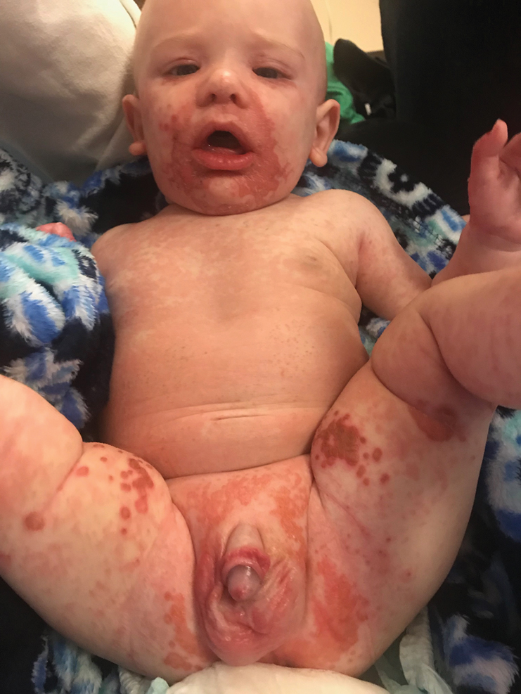 Irritable Baby Weight and a Periorificial and Truncal Rash | MDedge Dermatology