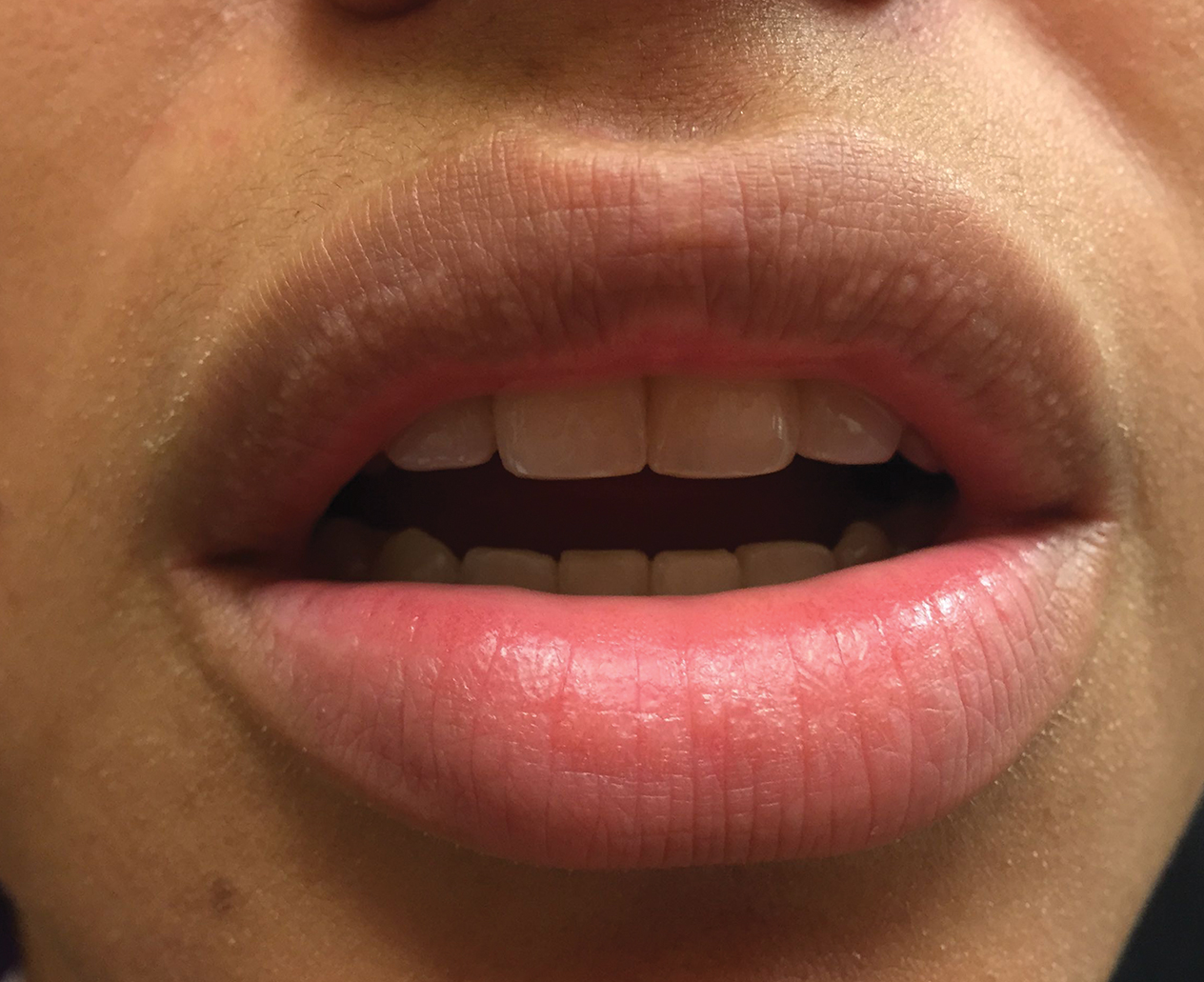 small-white-spots-on-the-lips-mdedge-dermatology