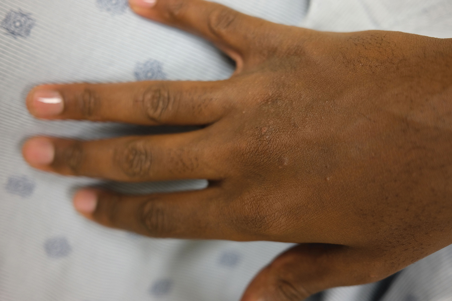 Lichenoid papules on the hand of a Black patient with atopic dermatitis