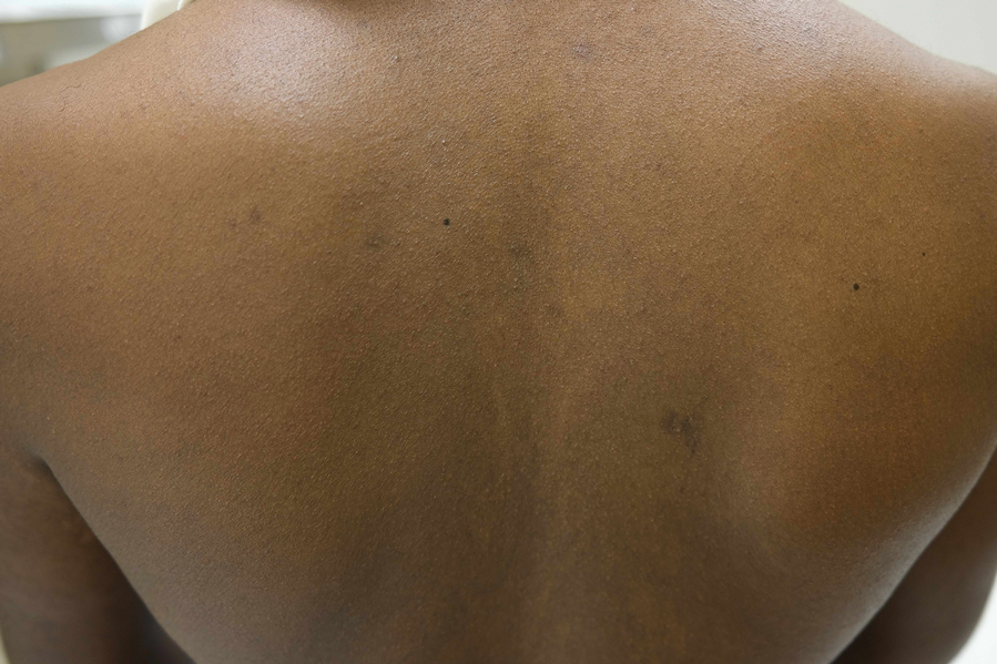 Perifollicular papules on the back of a Black patient with atopic dermatitis.