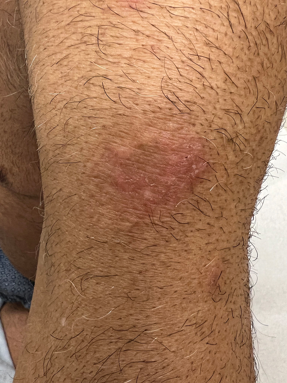 Nummular lesion on the arm of an Asian patient with atopic dermatitis.