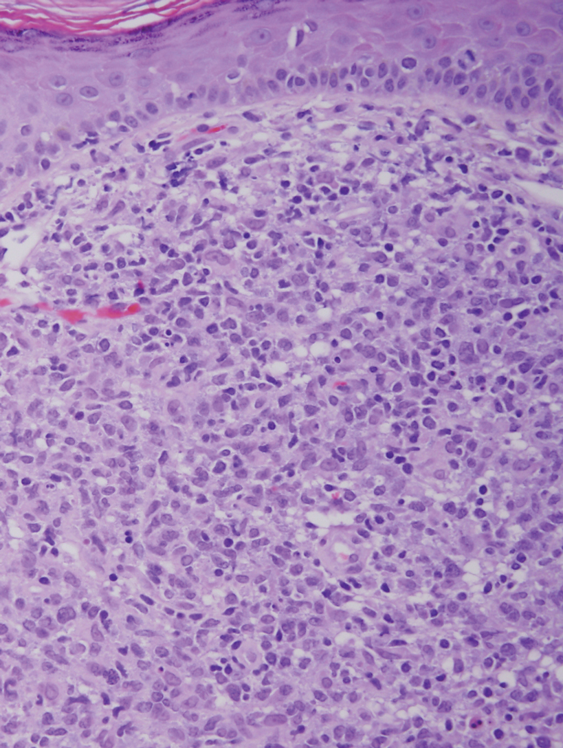 Diffuse large B-cell lymphoma, leg type