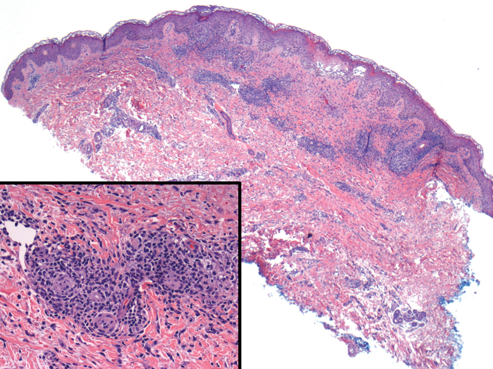 Adult T-cell leukemia/lymphoma