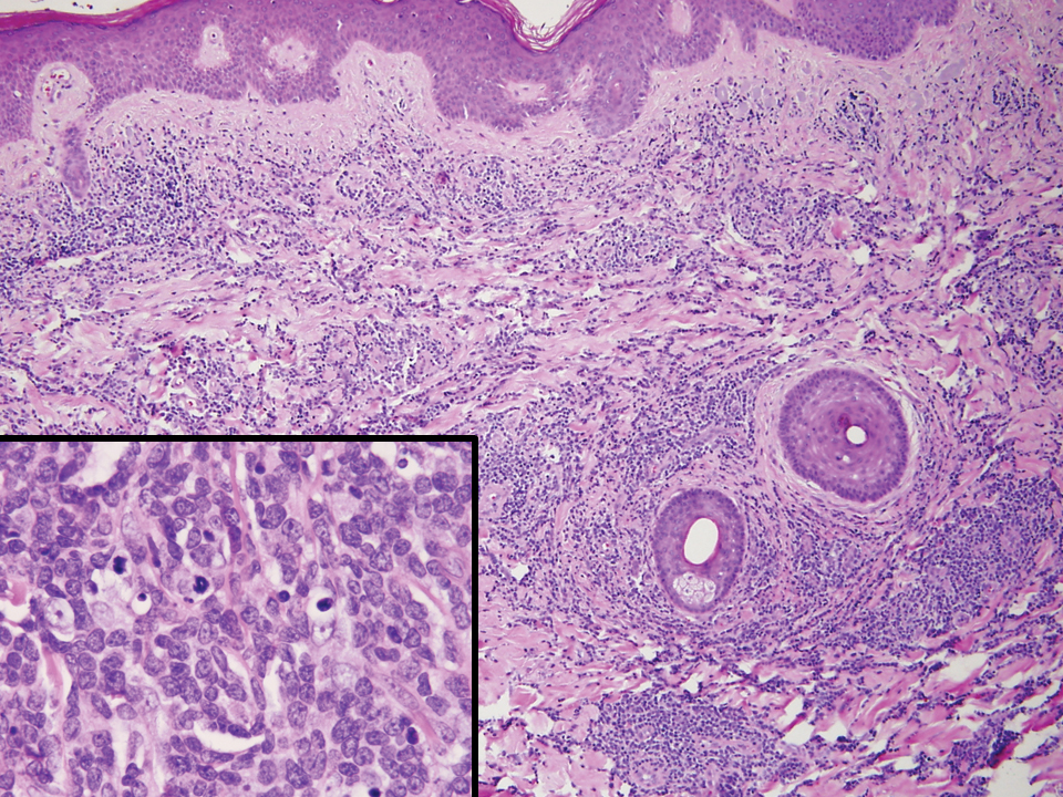 Cutaneous T-cell lymphoblastic leukemia/lymphoma