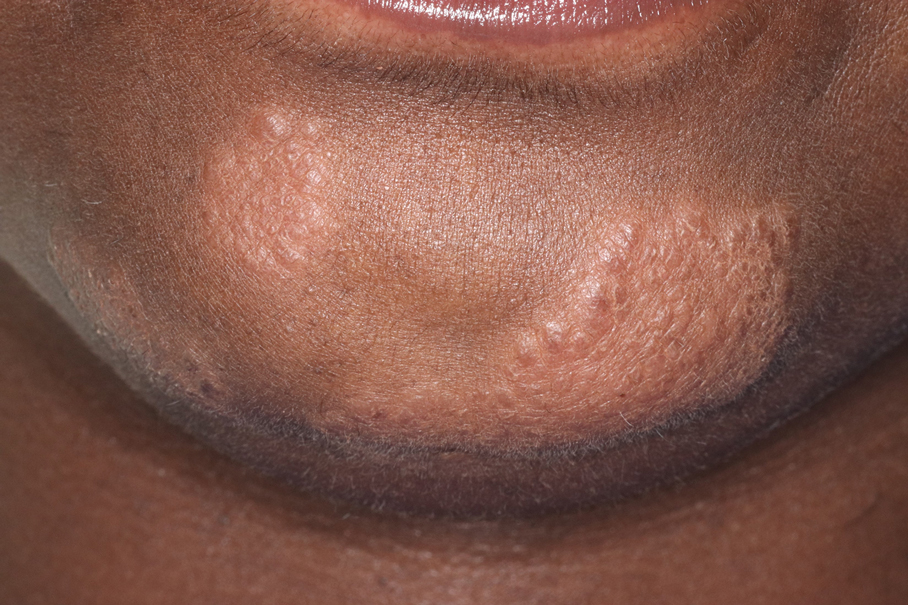 Indurated, flesh-colored to violaceous plaques on the chin in a patient with cutaneous sarcoidosis.