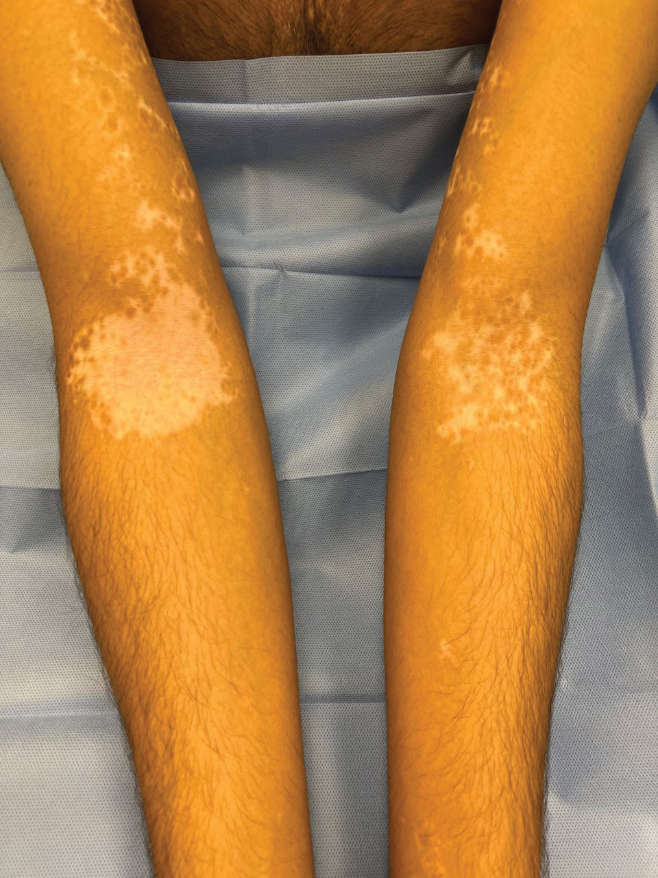 Vitiligo on the patient’s left arm was treated with ruxolitinib over a period of 36 weeks with remarkable repigmentation. In contrast, the patient’s right arm was not treated.