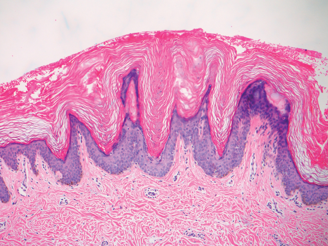 Dermatitis neglecta