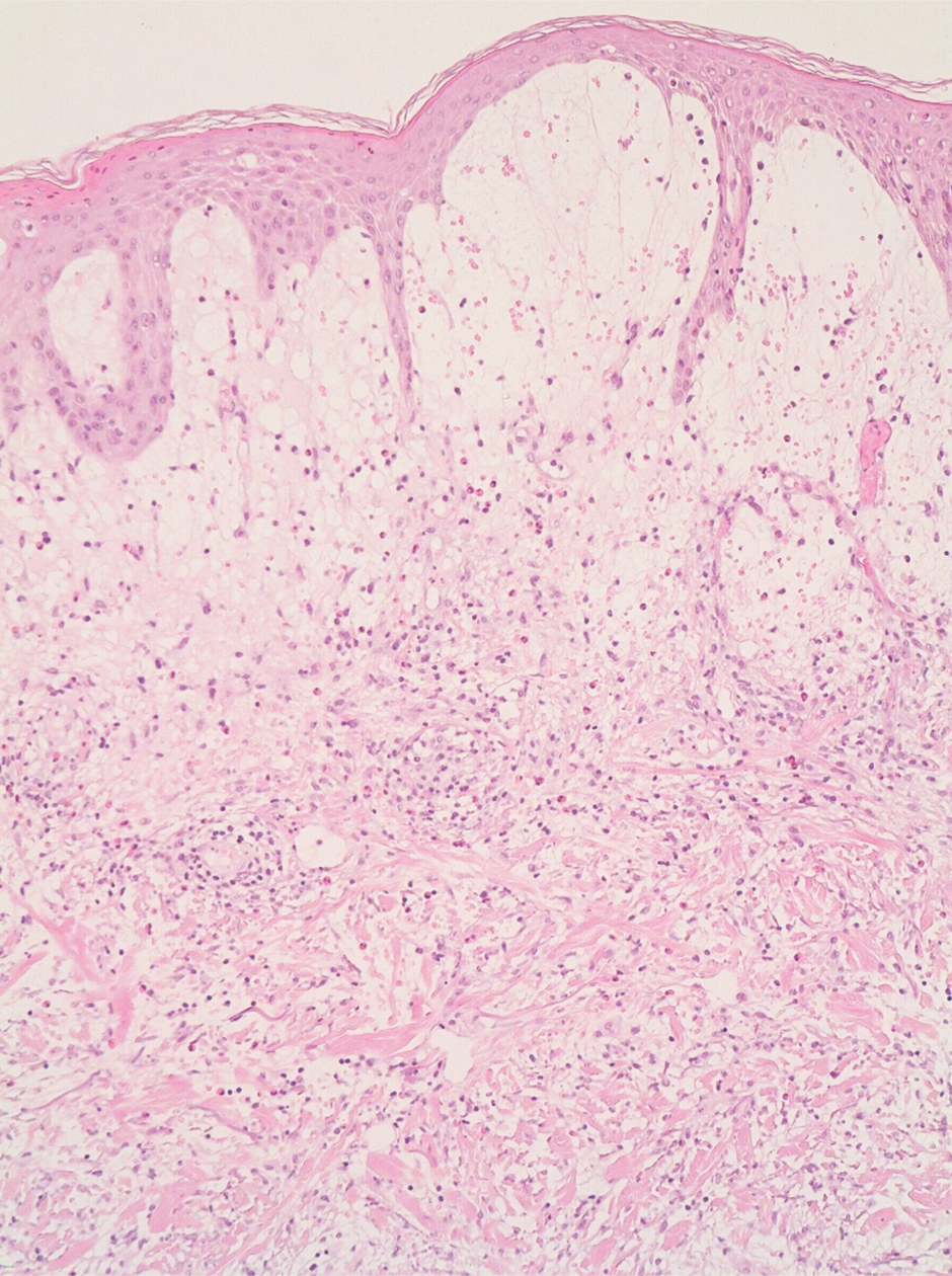 A biopsy of a neck lesion showed epidermal ulceration with notable edema in the papillary dermis with an intense inflammatory infiltrate in the papillary and reticular dermis