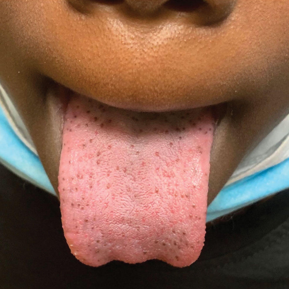Hyperpigmented papules on the tongue of a child