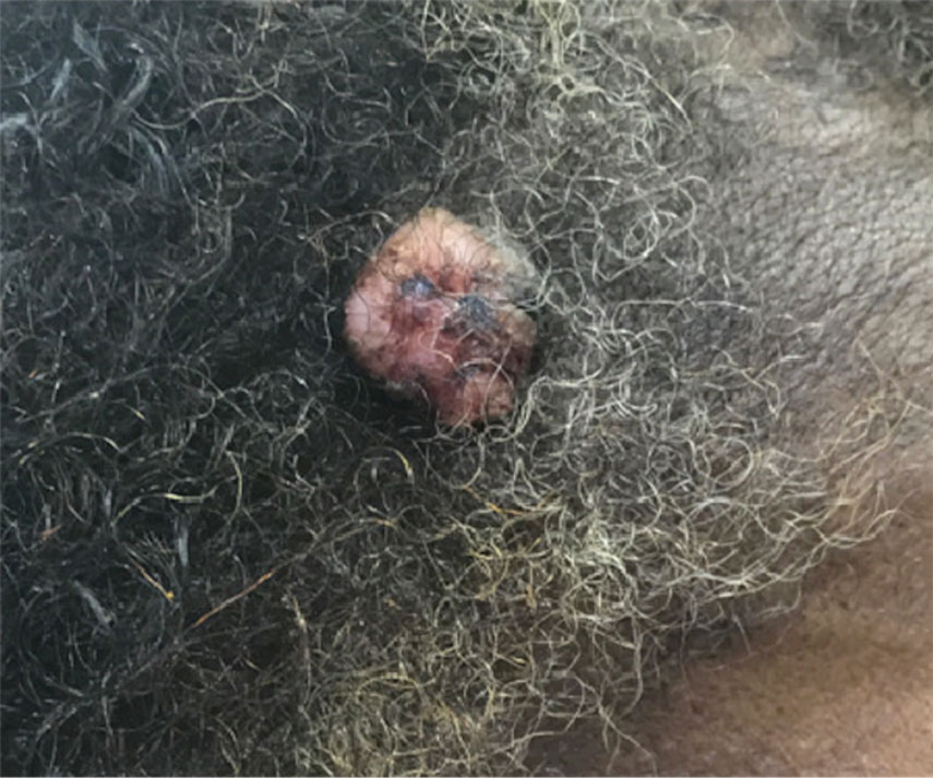 A 1.4-cm, heterochromic, pedunculated, keratotic tumor with crusting on the right temporal scalp that was diagnosed as porocarcinoma.