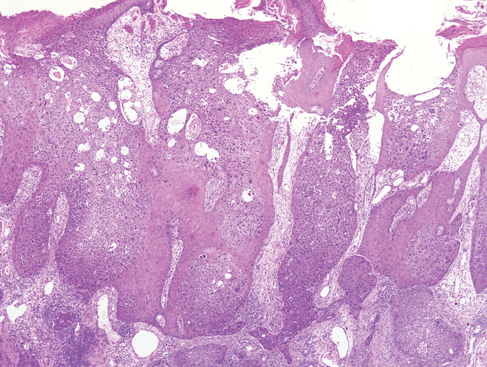 Histopathology revealed anastomosing epidermal strands of malignant cuboidal cells with ductular differentiation and less differentiated, deeper areas with necrosis (H&E, original magnification ×40).