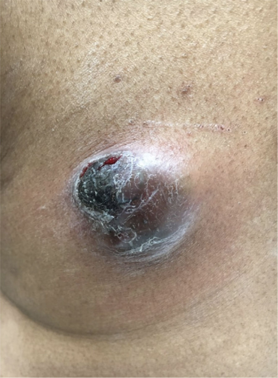 A firm, tender, erythematous to black nodule measuring 3.0×2.8 cm on the left mid back inferior to the left scapula that was diagnosed as porocarcinoma.