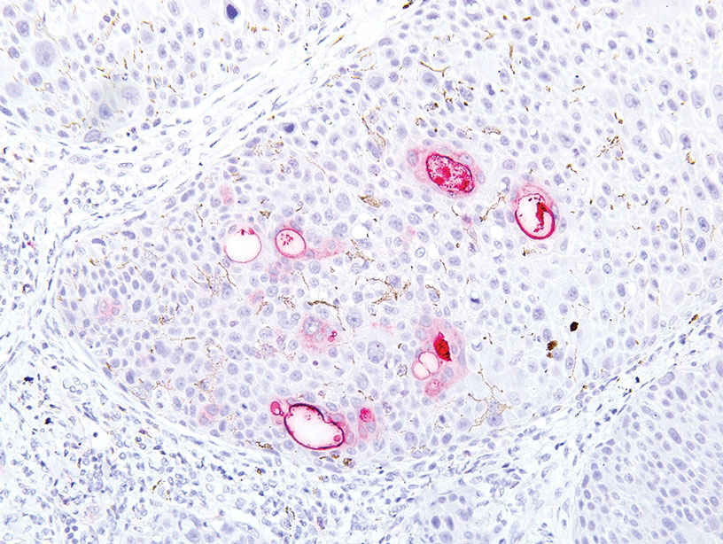 Eccrine Porocarcinoma In 2 Patients Mdedge Dermatology