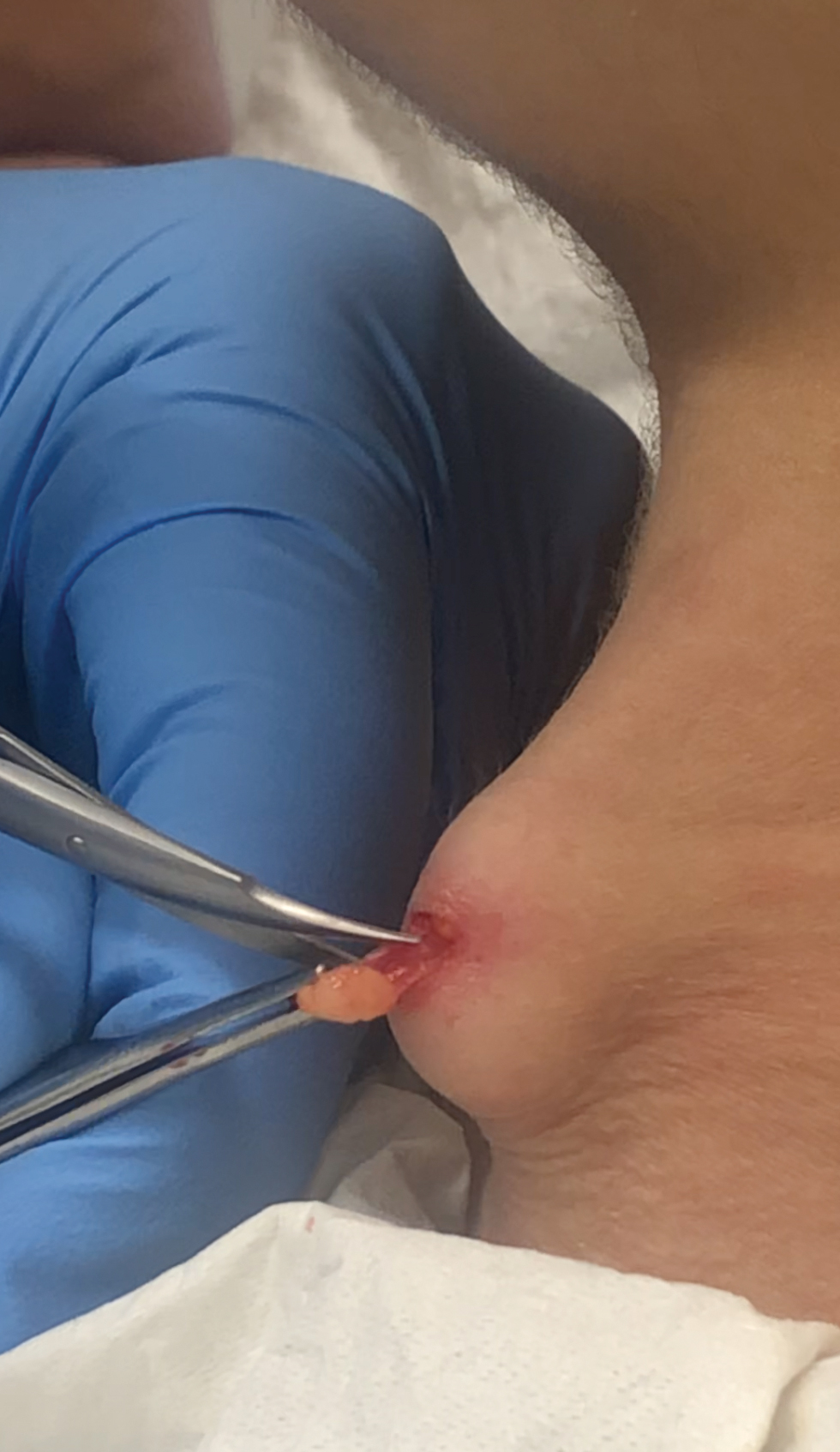 Surgical excision of a nodule was performed, with the nodule tightly embedded in the underlying tissue.