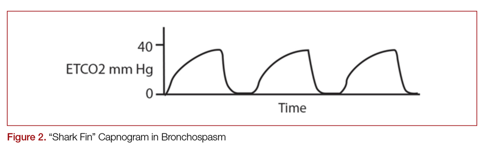 “Shark Fin” Capnogram in Bronchospasm