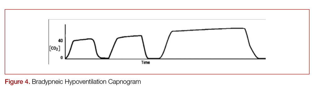 Bradypneic Hypoventilation Capnogram