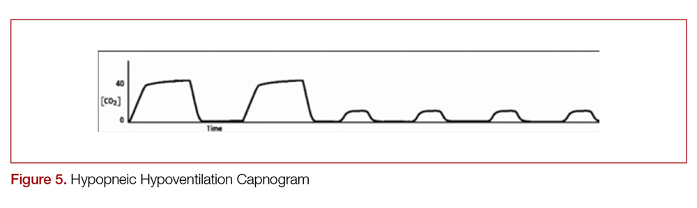 Hypopneic Hypoventilation Capnogram