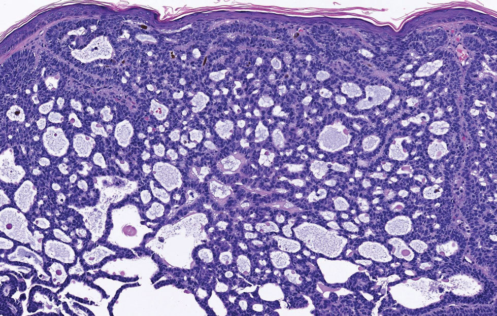 Basal cell carcinoma (adenoid type)