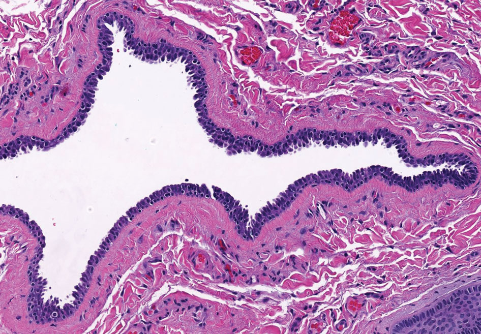 Apocrine hidrocystoma