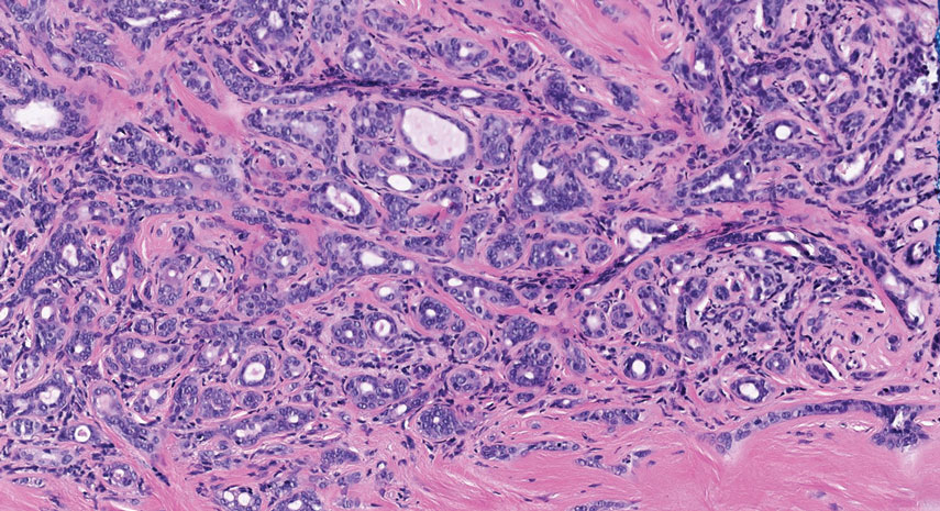 Microcystic adnexal carcinoma