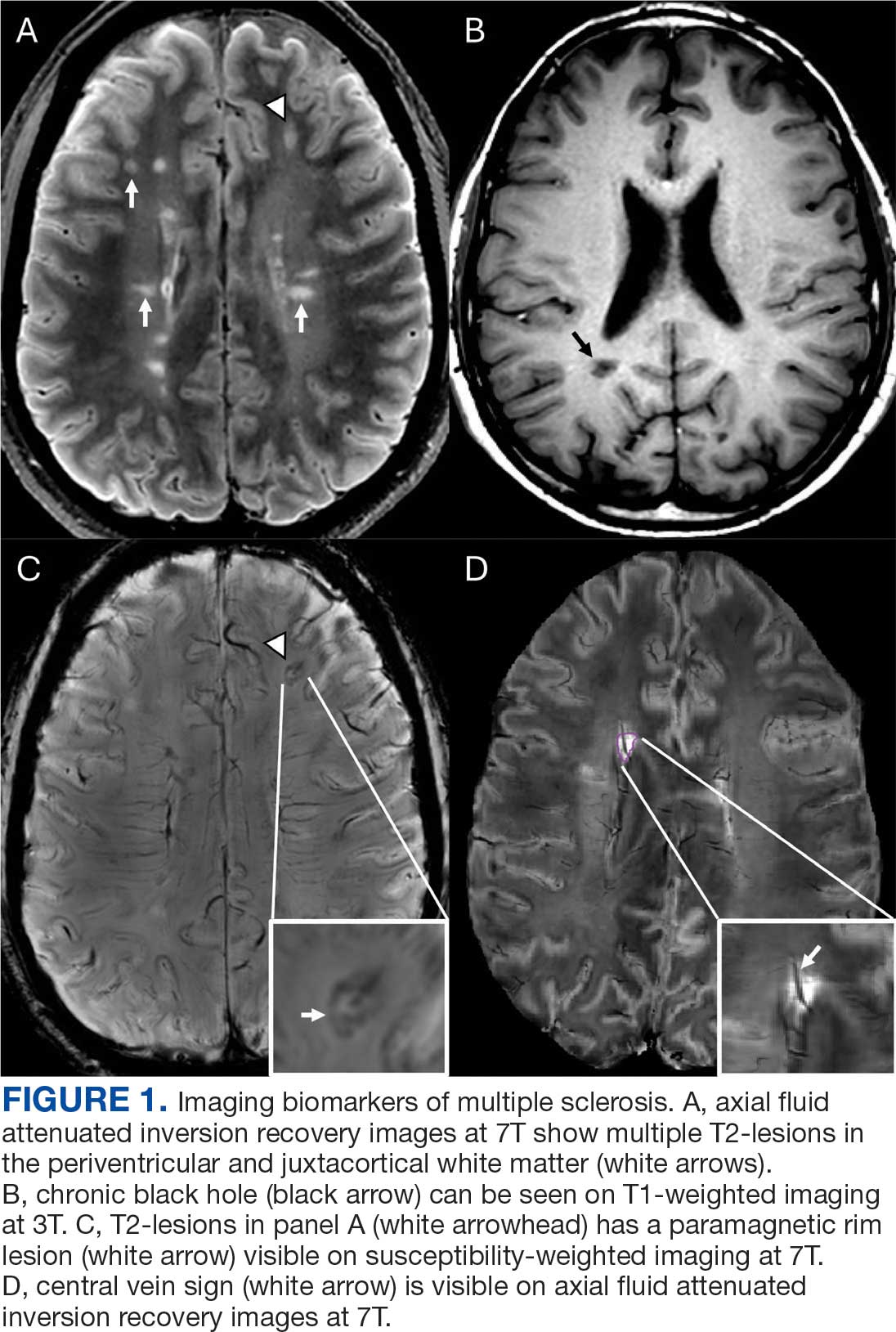Multiple Sclerosis Mri Sign