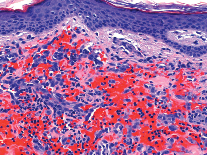 Histopathology revealed a papillary dermis containing a proliferation of irregularly shaped vascular spaces with plump endothelium (H&E, original magnification ×200).