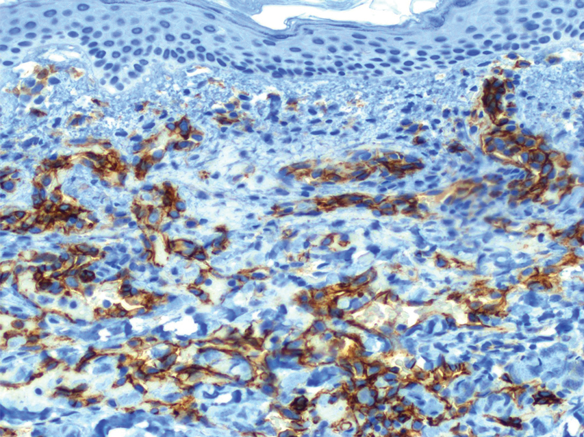 Positive direct immunofluorescence staining (brown pigment) of a punch biopsy specimen of endothelium confined to lymphatic vessels with D2-40 (original magnification ×200). 