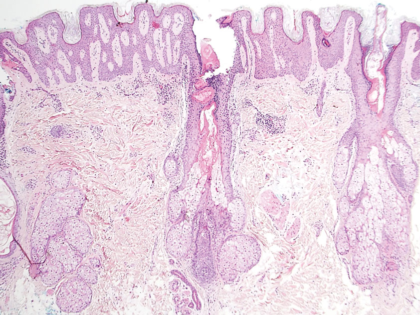 Histopathology revealed the sebaceous glands emptied directly onto the skin surface (H&E, original magnification ×40).