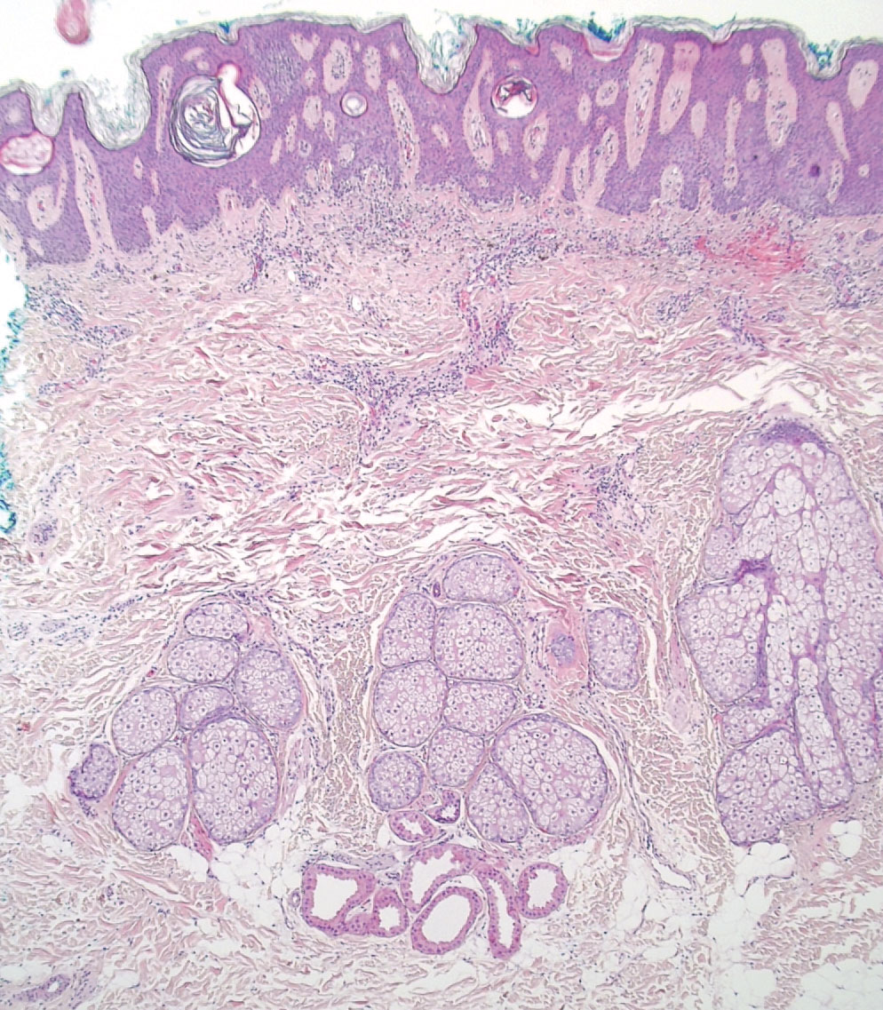 Apocrine glands were visible below the level of the sebaceous glands on histopathology (H&E, original magnification ×20).