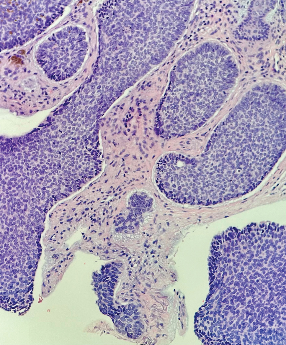 Basal cell carcinoma