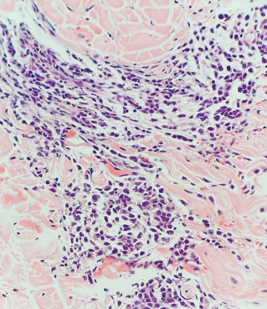 Leukemia cutis