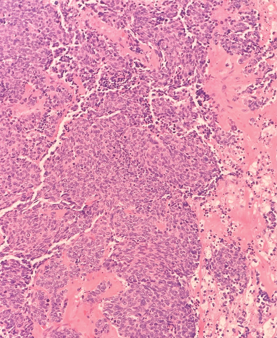 Metastatic small cell carcinoma