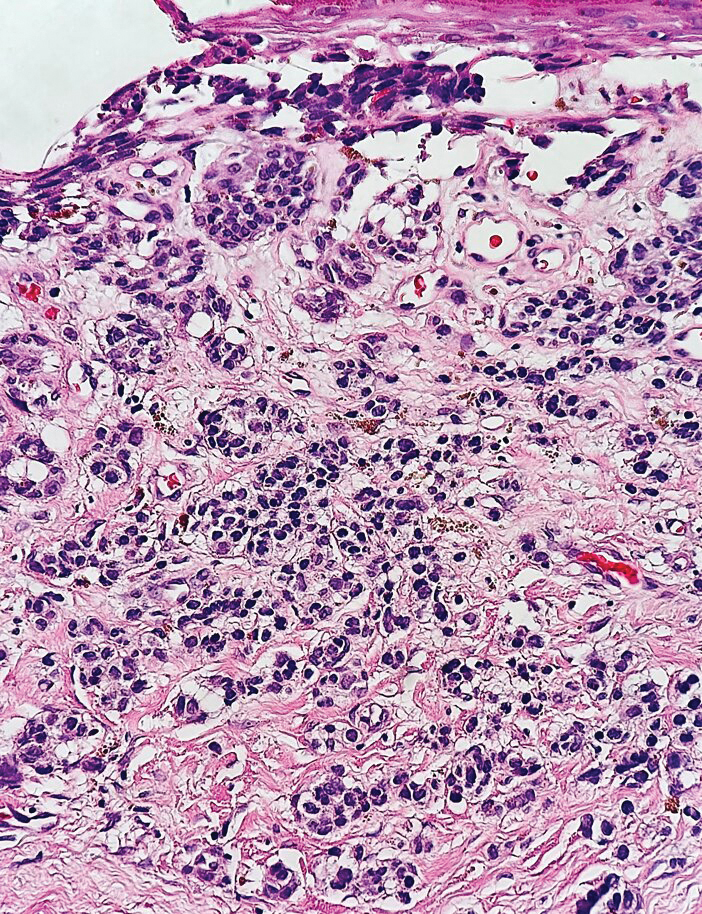 Small cell melanoma