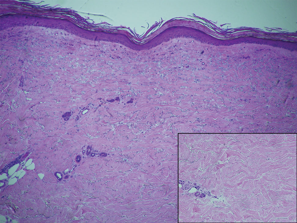 Punch biopsy of a nonirradiated field on the right thigh showed thickened and sclerotic collagen bundles (inset) extending into the subcutaneous tissue with a perivascular lymphoplasmacytic infiltrate (H&E, original magnification ×40 [inset, original magn