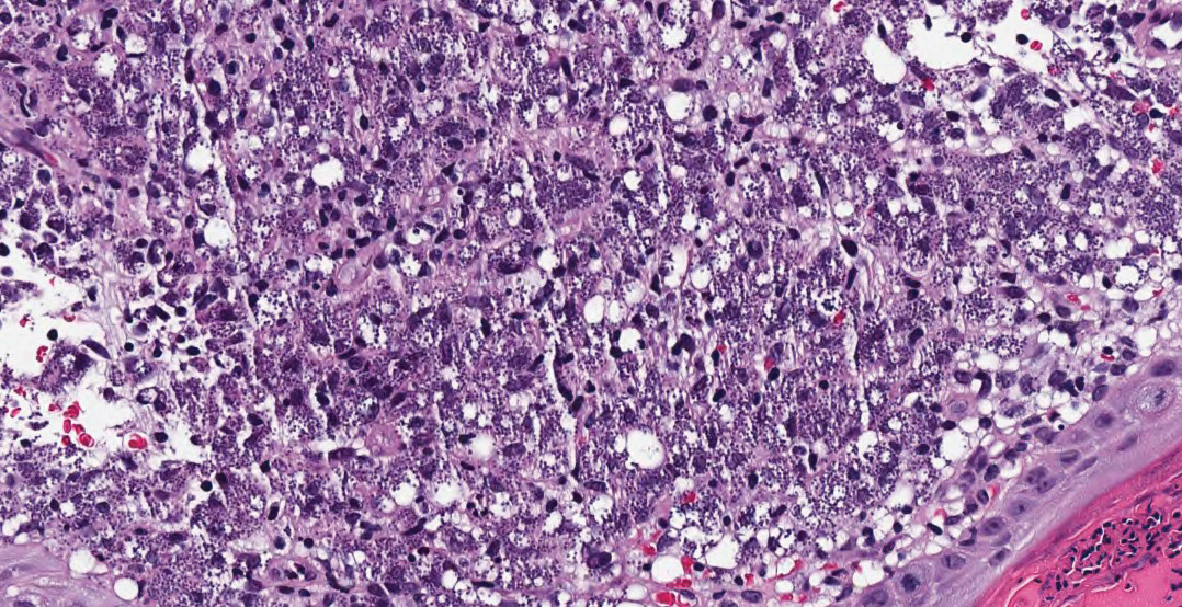 Dense histiocytic infiltrate with scattered lymphocytes and neutrophils as well as round to oval basophilic structures within the macrophages. There were collections of neutrophils, parakeratosis, and a serum crust overlying the epidermis