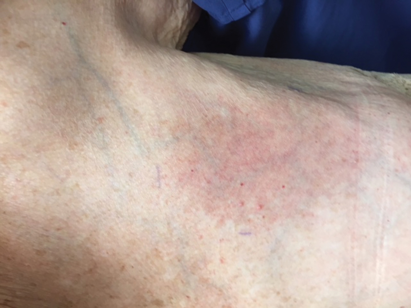 Radiation Recall Dermatitis Triggered by Prednisone