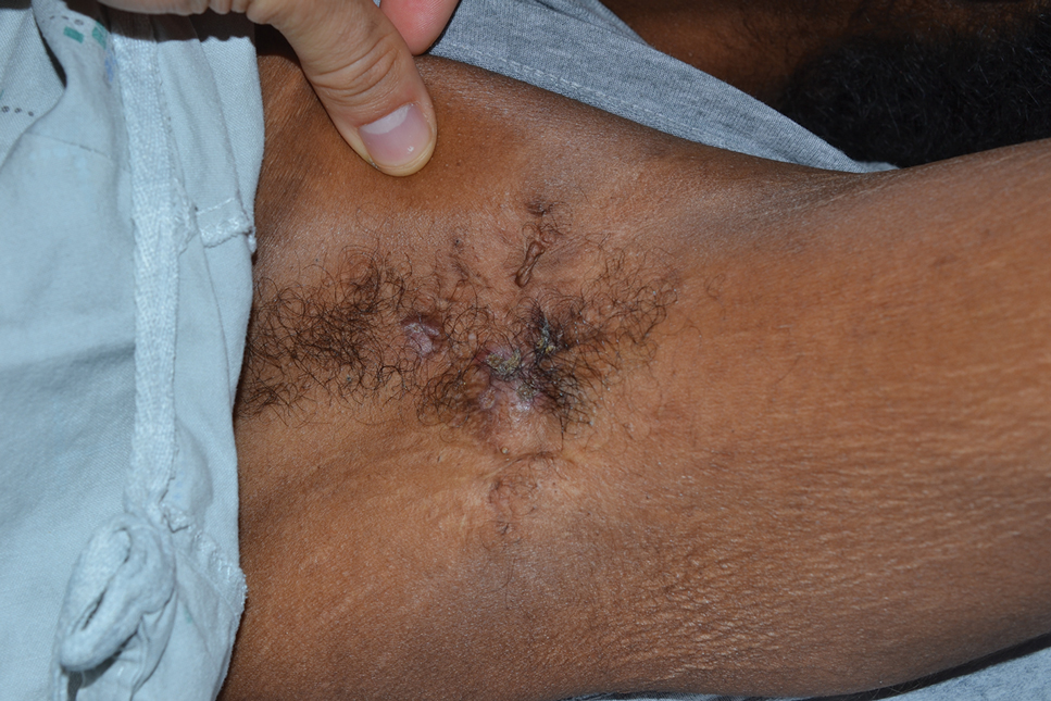 Tender Nodular Lesions in the Axilla and Vulva