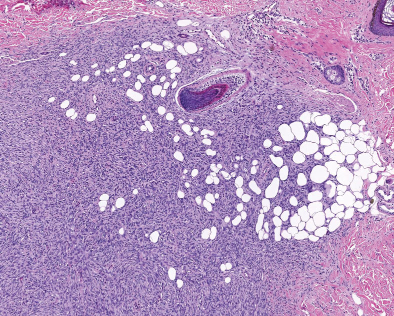 Dermatofibrosarcoma protuberans. Sheets of spindle cells are arranged in a storiform pattern proliferating within the dermis and infiltrating the fat in a honeycomblike pattern (H&E, original magnification ×100).