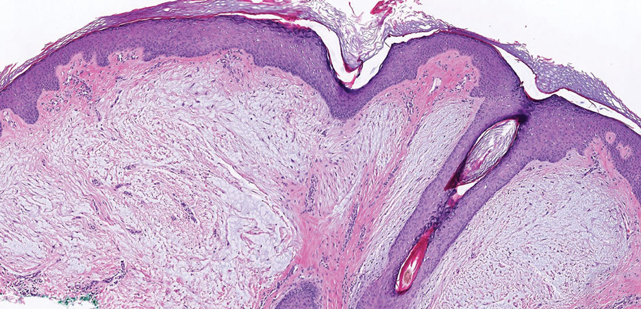 Superficial angiomyxoma. Abundant myxoid stroma and small spindled and stellate cells are present with minimal cytoplasm and surrounding thin blood vessels (H&E, original magnification ×40).