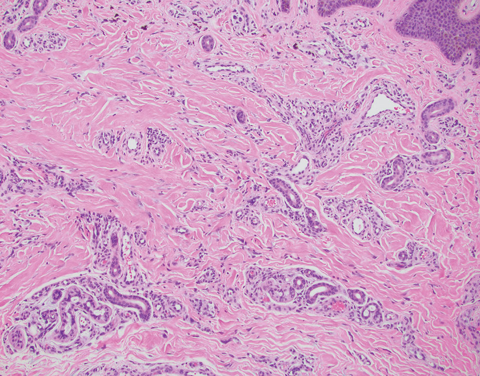 Multinucleate cell angiohistiocytoma. Fibrosis of the superficial dermis is present with scattered small-caliber vessels and fibrohistiocytic cells (H&E, original magnification ×40).