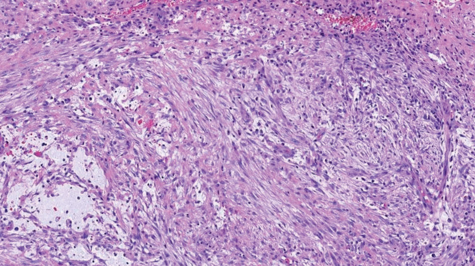 Nodular fasciitis. Slender, loosely aggregated, spindled cells with a tissue culture–like appearance can be seen (H&E, original magnification ×200).