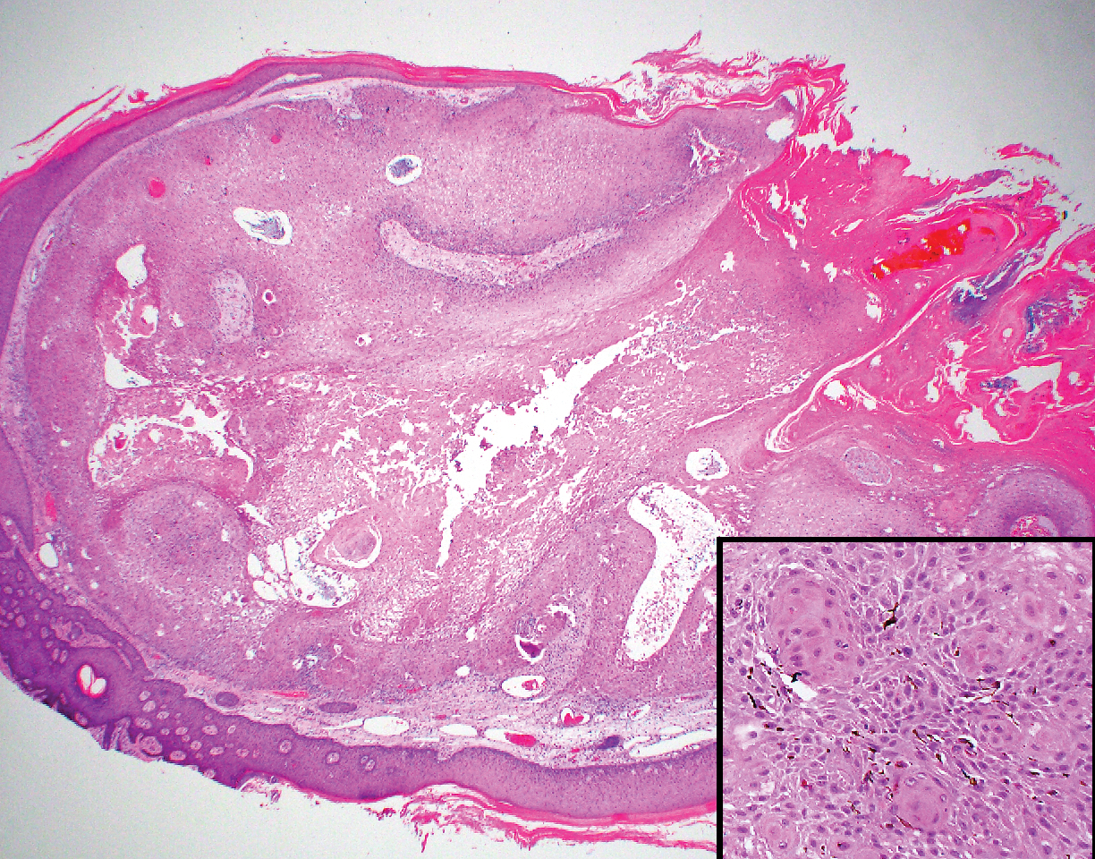 Ulcerated Nodule on the Scalp | MDedge Dermatology