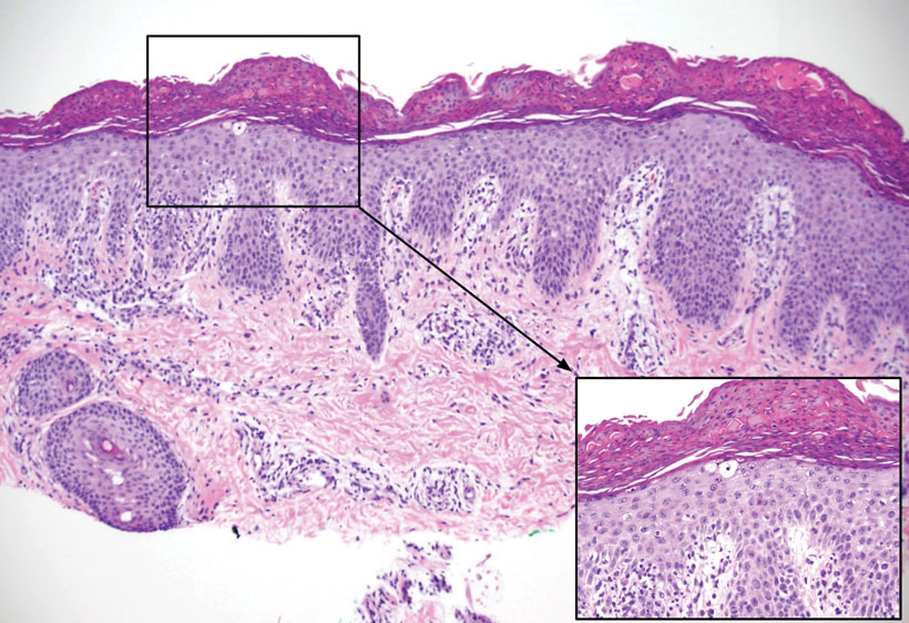 Biopsy of the left axilla showed psoriasiform hyperplasia with overlying confluent parakeratosis, focal spongiosis, multiple dyskeratotic keratinocytes, and mitotic figures