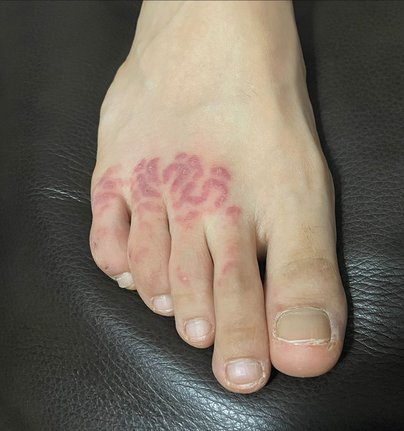 Nonblanching, erythematous, cerebriform plaques on the foot